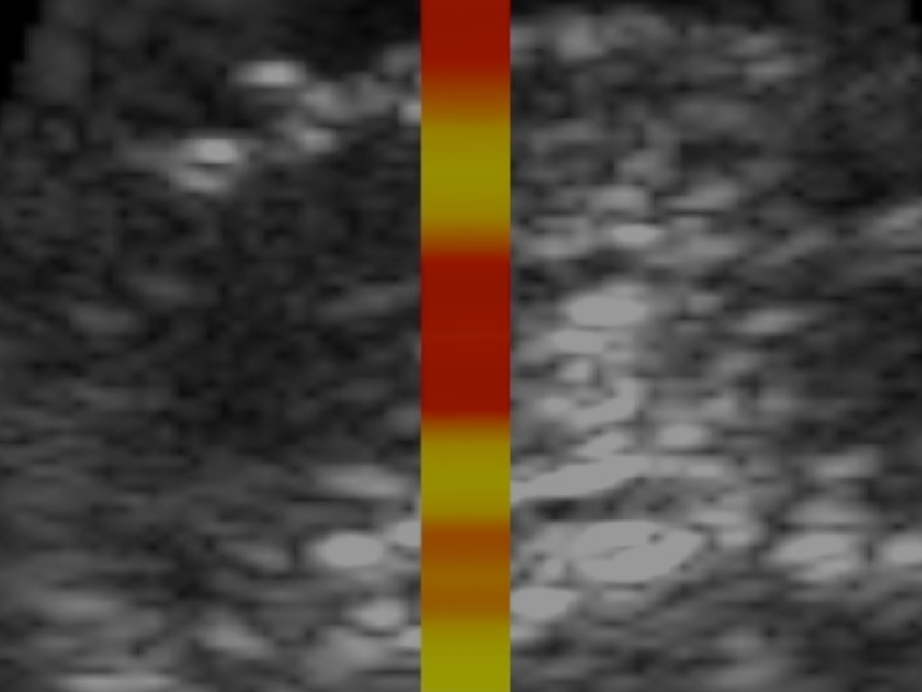 Ultrasound is used to measure the tissue depths of the fat/muscle boundary and liver capsule. A corresponding TAEUS® thermoacoustic reconstruction is generated, and relevant signals are extracted to quantify tissue metrics.